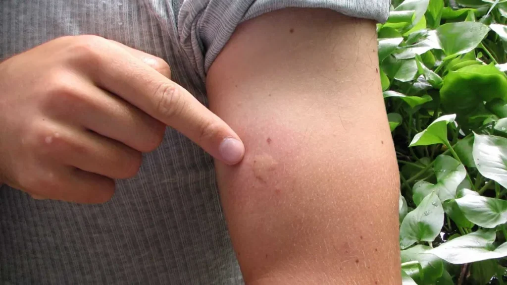 Do Pimple Patches Work on Mosquito Bites?