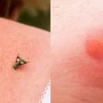 Can You Use Pimple Patches on Bug Bite?