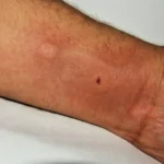 Do Pimple Patches Help Bug Bites? The Surprising Truth
