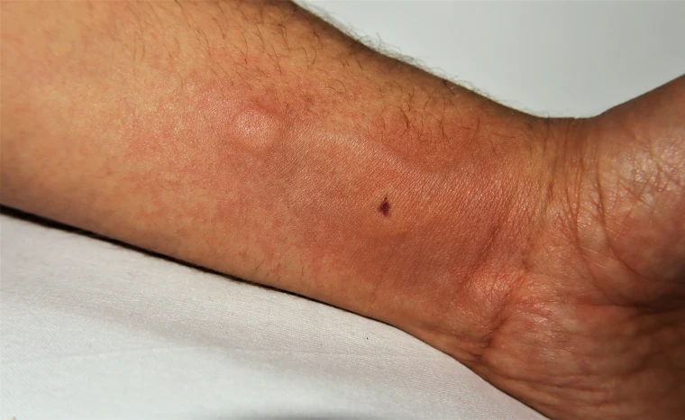 Pimple Patches Help Bug Bites