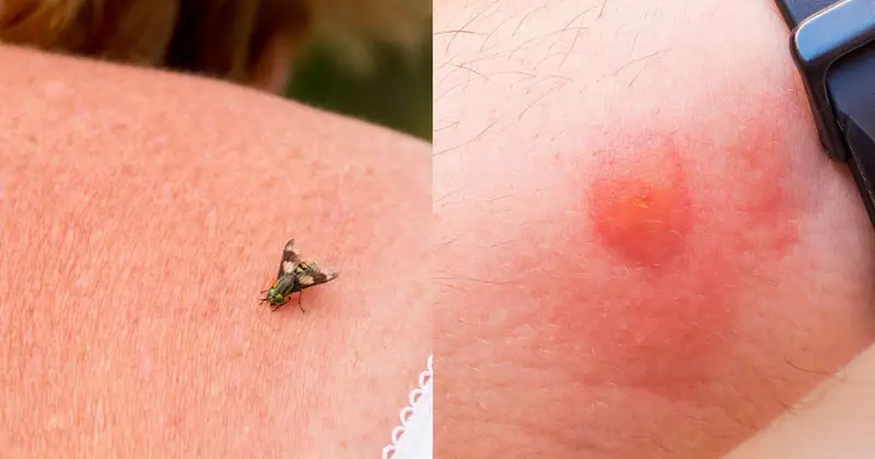 Bug Bites