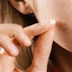 Pimple Patches for Bug Bites: Relief or Just Hype?